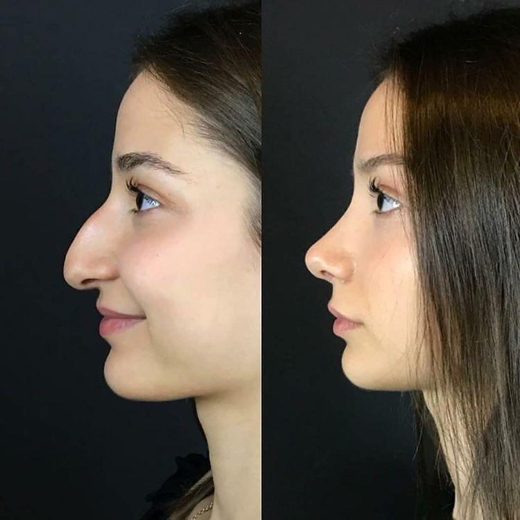 fascinating photos --  nose surgery transformation