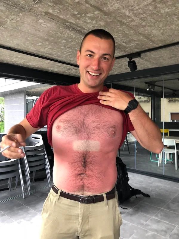 23 Sunburns From Hell.