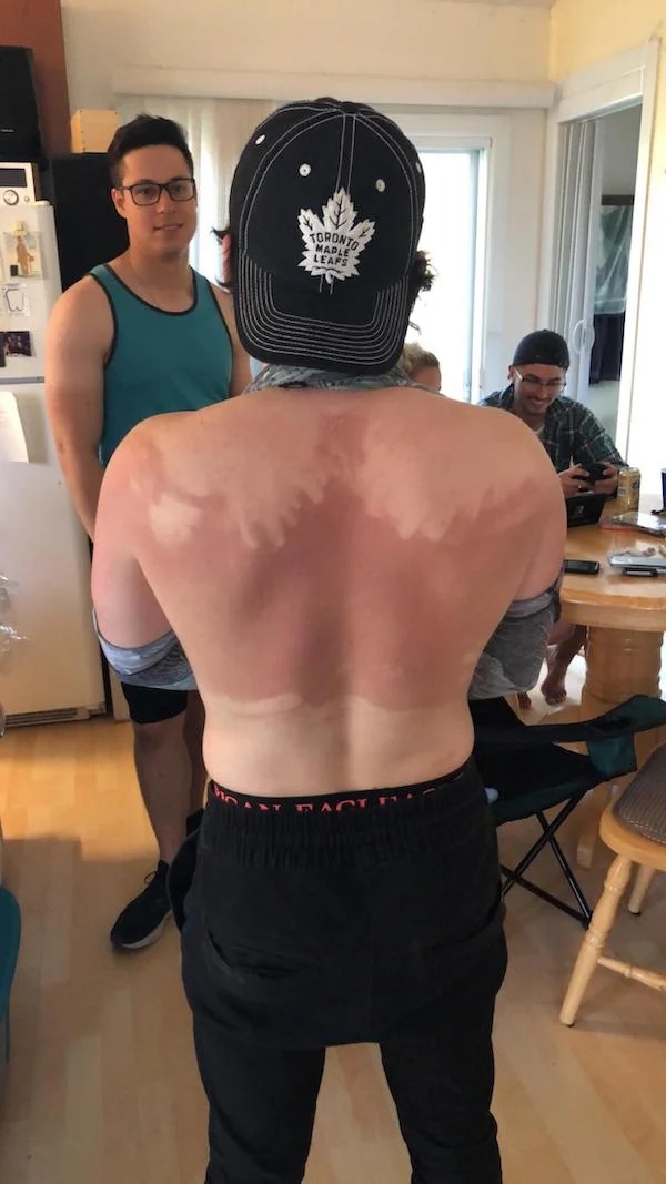 23 Sunburns From Hell.