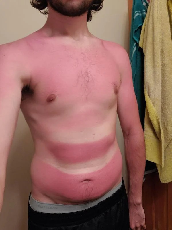 23 Sunburns From Hell.