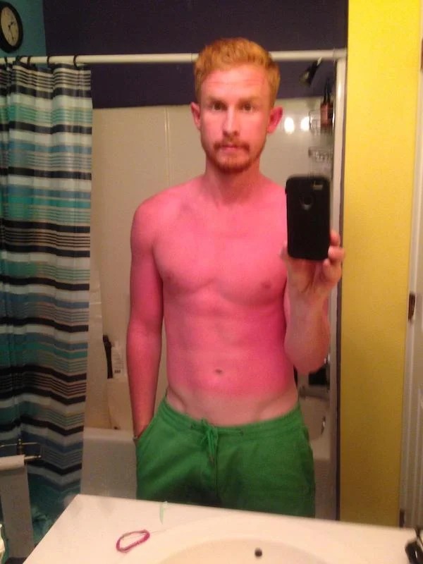 23 Sunburns From Hell.