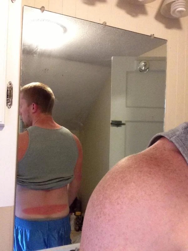 23 Sunburns From Hell.