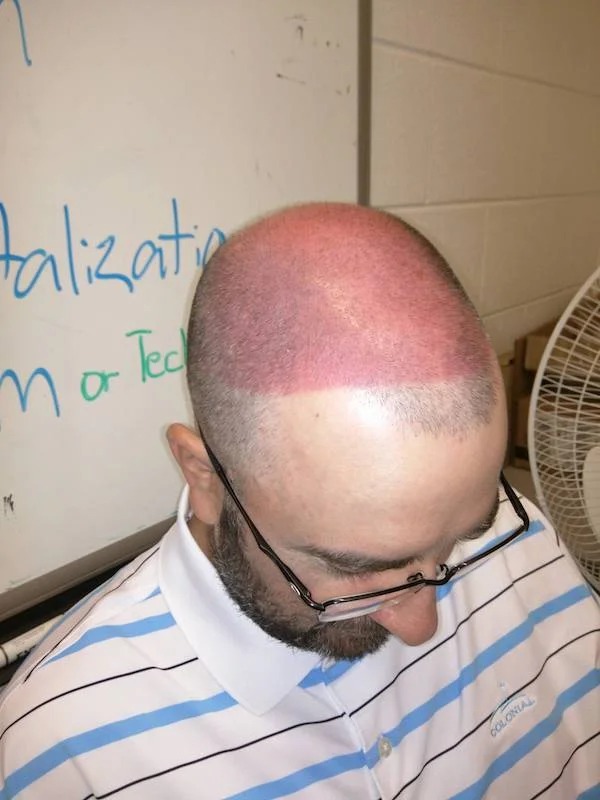 23 Sunburns From Hell.