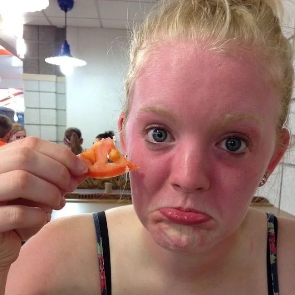 23 Sunburns From Hell.
