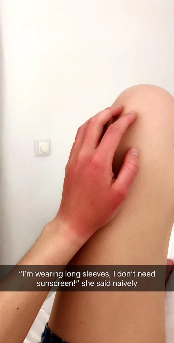 23 Sunburns From Hell.