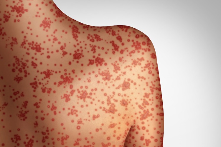 The measles virus actually causes immunity amnesia, meaning your immune system has to “relearn” how to fight off viruses and bacteria you were previously immune to.

Measles wipes out 11-73% of the antibodies your body uses to protect against viruses and bacteria. This can last for up to 2-3 years.

One of the most amazing facts that highlights the importance of the measles vaccine
