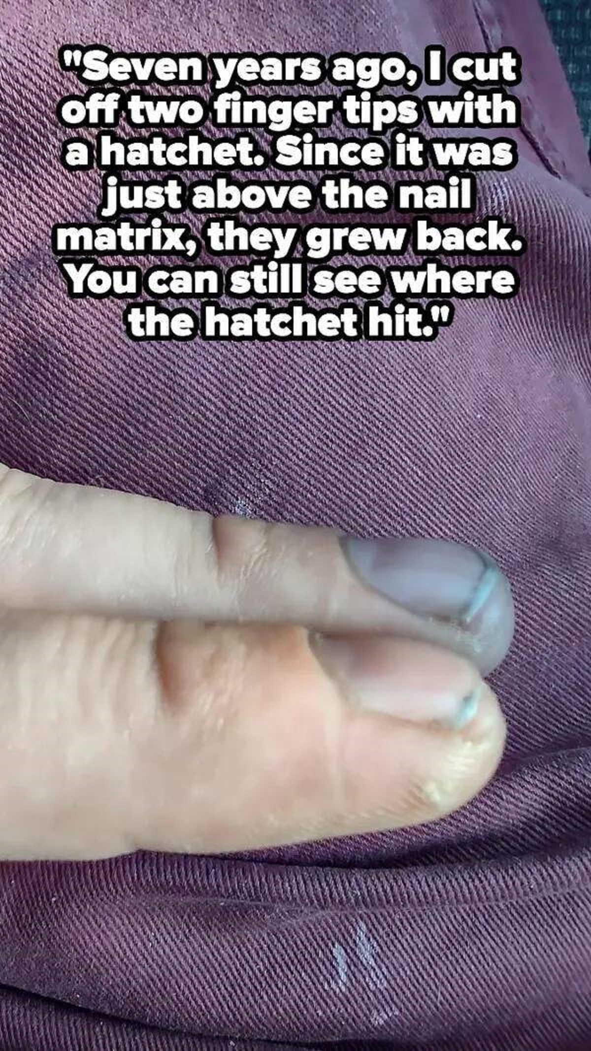 fascinating photos - hand - "Seven years ago, I cut off two finger tips with a hatchet. Since it was just above the nail matrix, they grew back. You can still see where the hatchet hit."