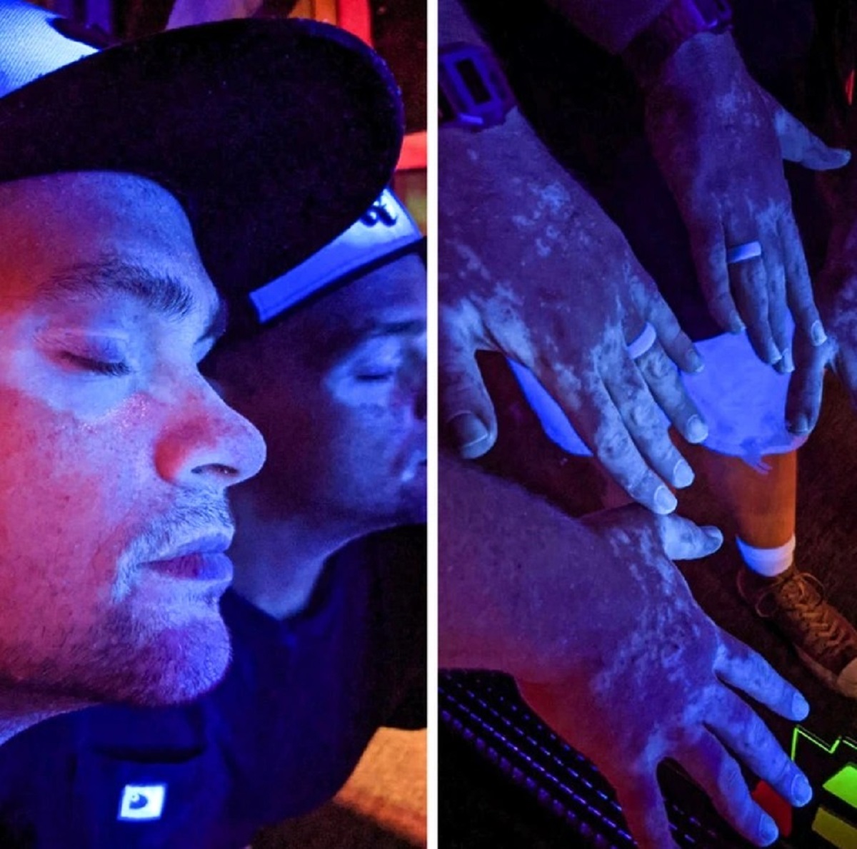 “My vitiligo under black light”