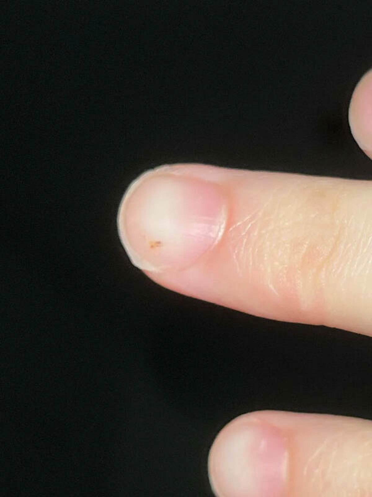 “My entire nerve is shot just by this little mark under my nail. I was giving my cat a French fry and accidentally rammed his molar into my finger. My entire nerve up my arm is damaged.”