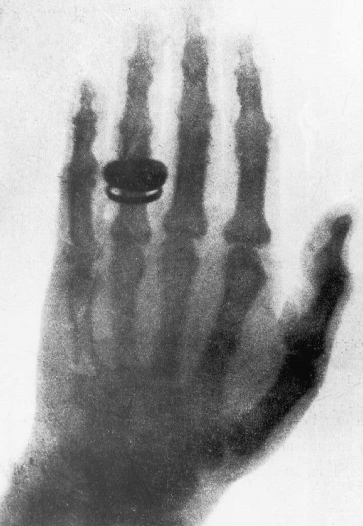 This X-ray, taken by Wilhelm Conrad Röntgen, is the first X-ray ever: