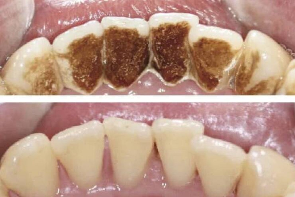 "A smoker's teeth before and after cleaning."