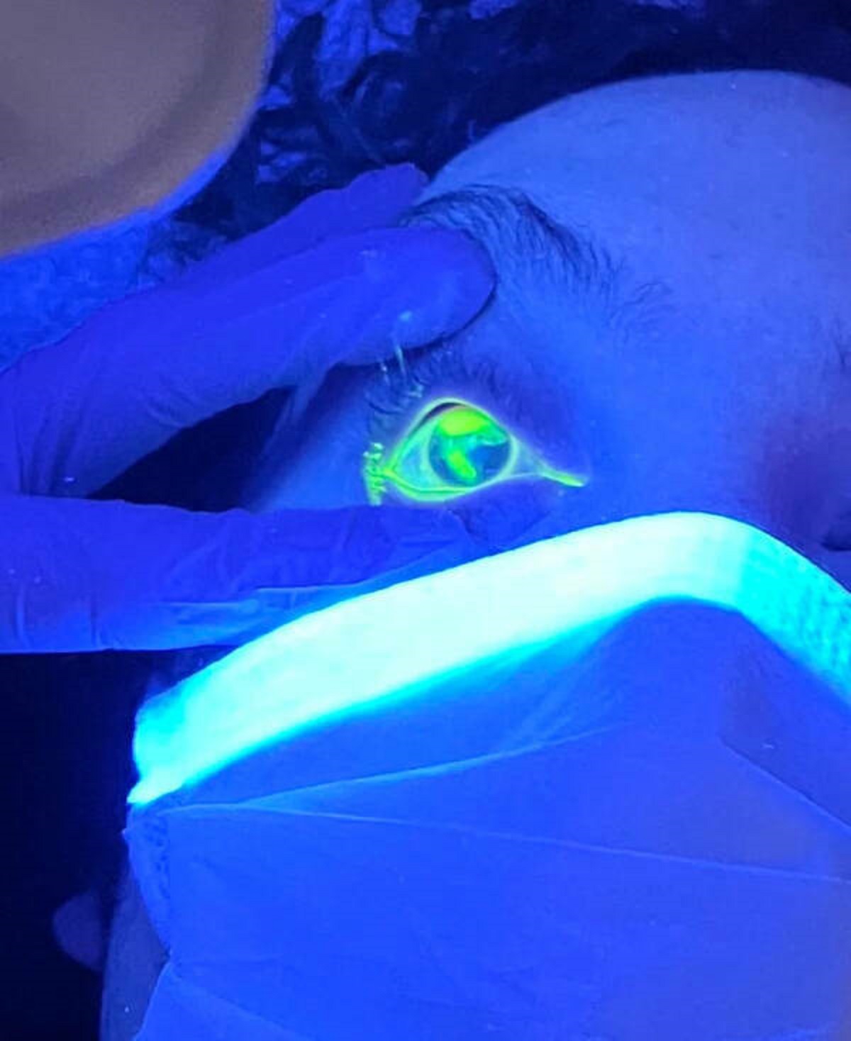 “Fluorescent eyedrops showing scratches on my cornea”
