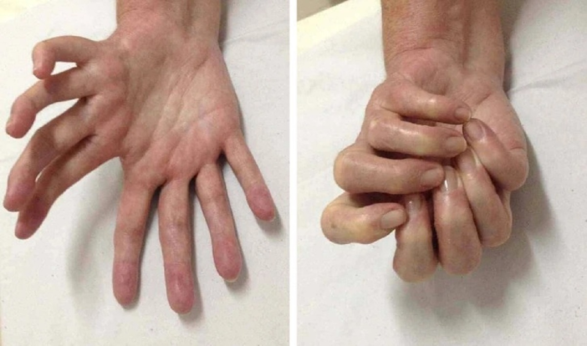 A person with an extremely rare condition called mirror hand