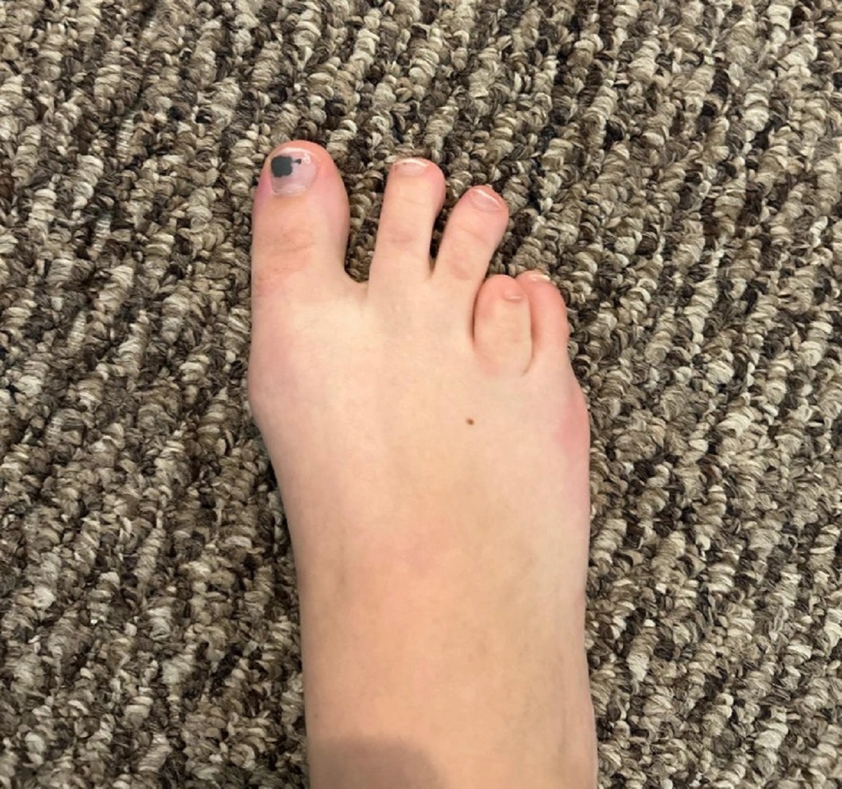 “I was born with 9.5 toes.”