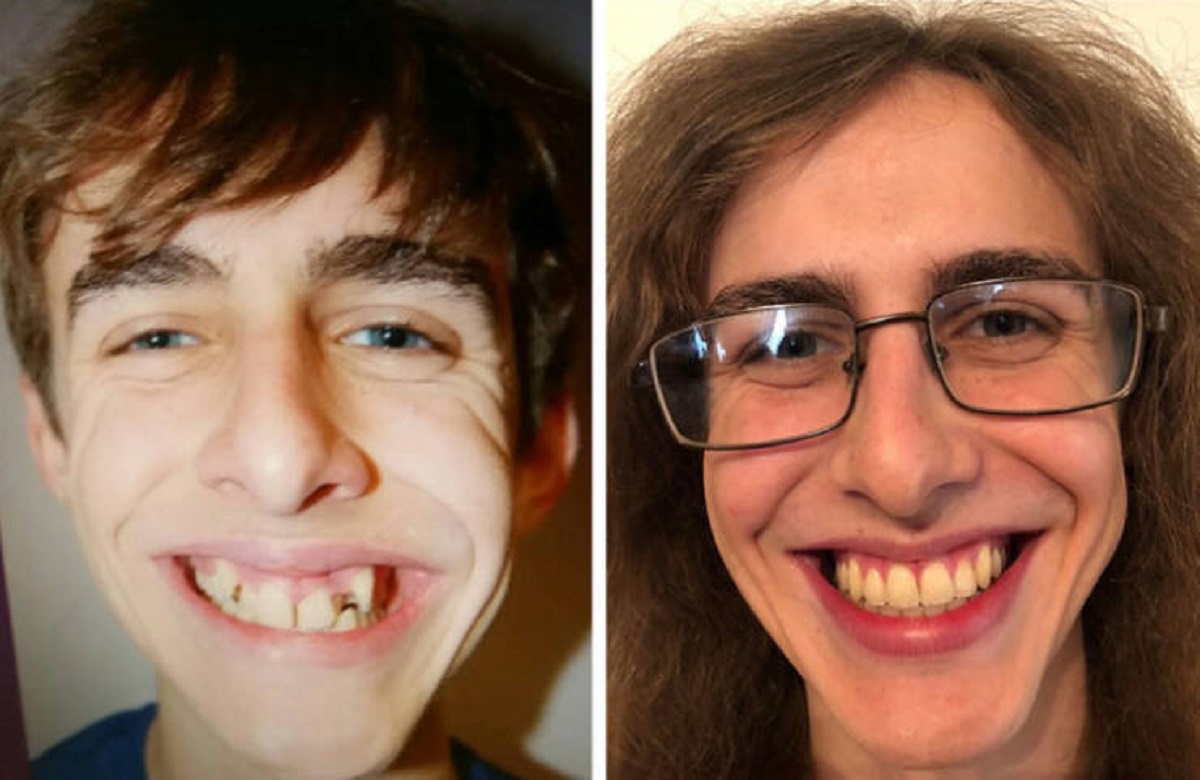 “2 years, 11 months and 20 days of braces. Worth every second”