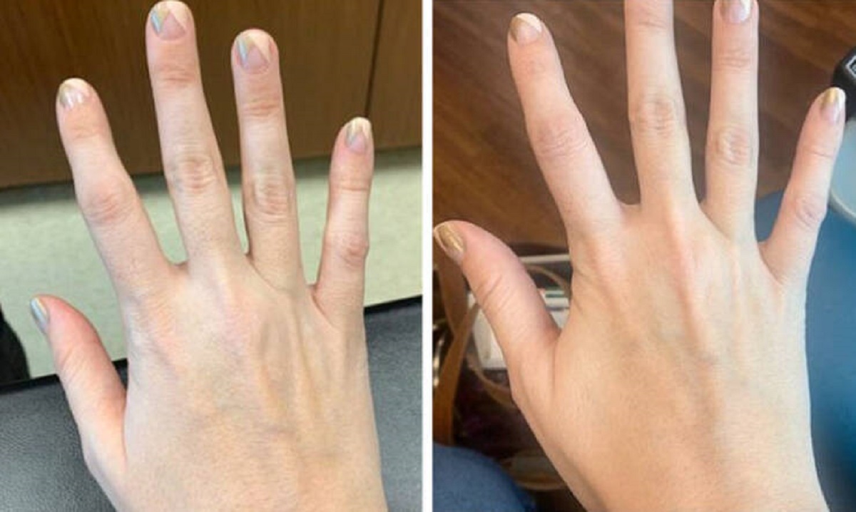 “My hand before and six hours after the iron injection”.