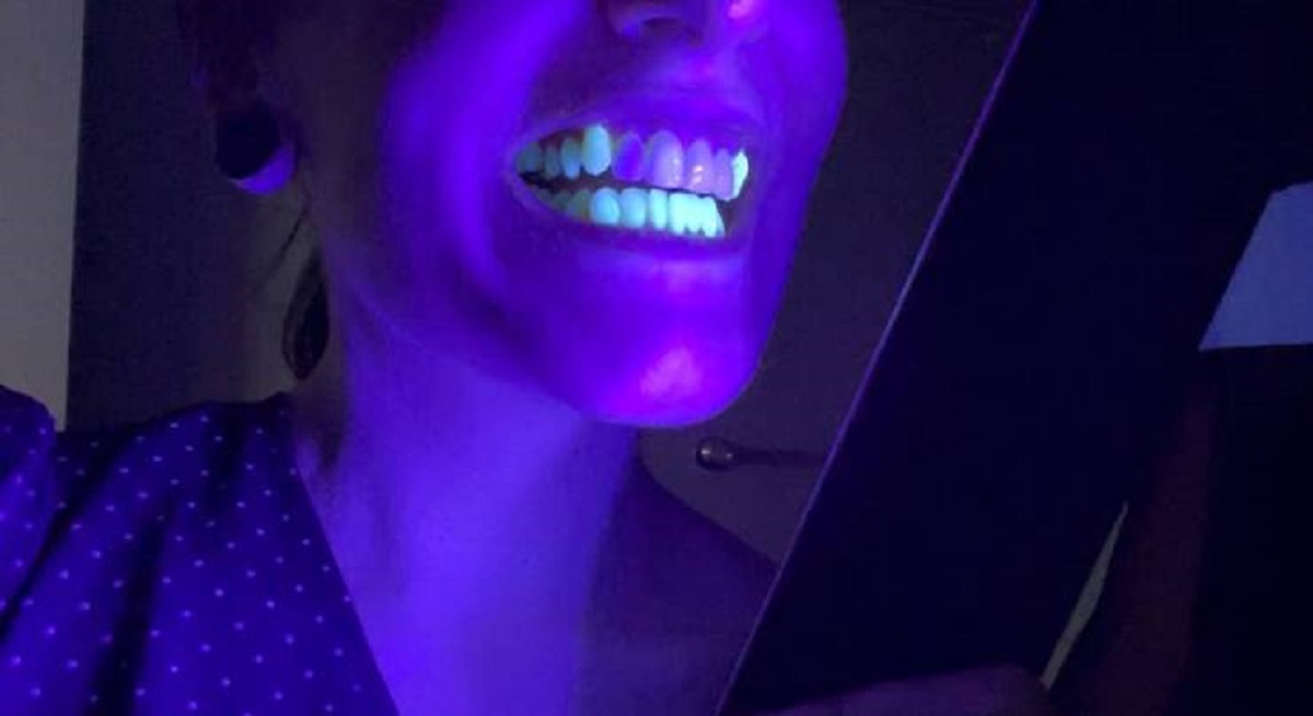 Veneers don't glow under a blacklight: