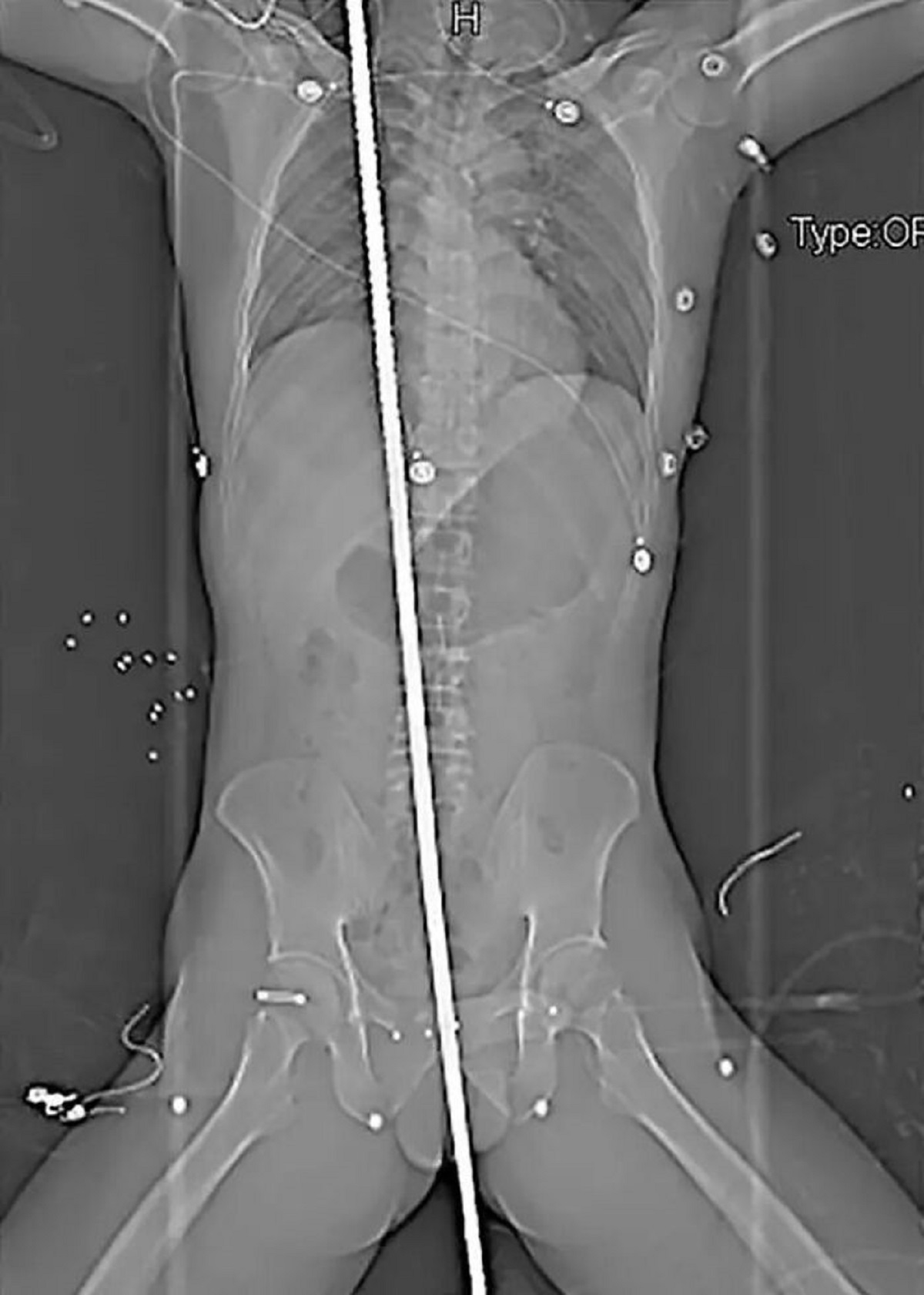 In 2017, Yang Ming, a 37-year-old, was thrown backward onto a protruding metal rod after accidentally coming into contact with a live wire at a construction site.

His coworkers opted to leave the pole in place and quickly transported him to the hospital, where surgeons could safely extract it.

Ming underwent a successful seven-hour surgery at Sichuan University West China Hospital, during which the protruding rod was safely removed. Fortunately, the rod missed all vital organs, and he survived.