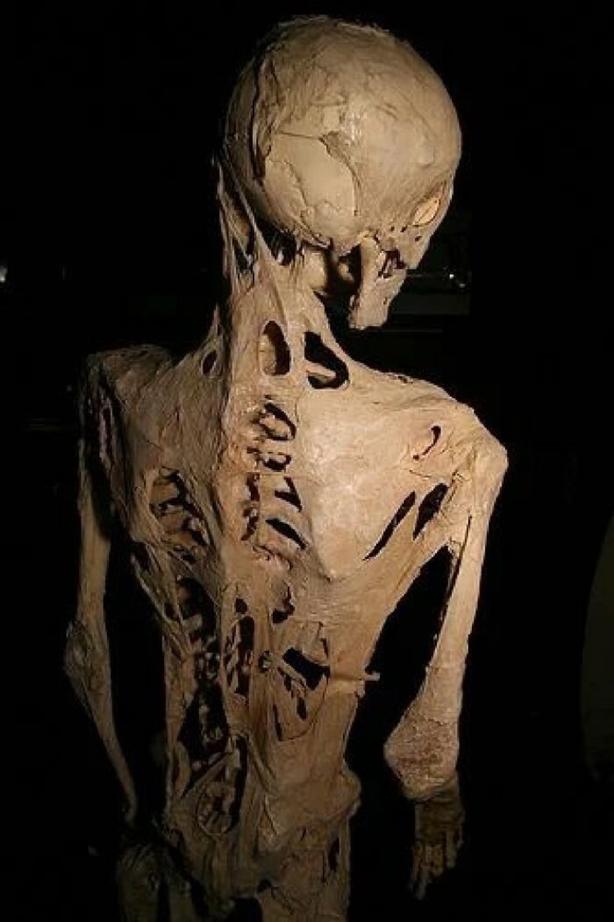 The skeleton of Harry Eastlack, a man that suffered from fibrodysplasia ossificans progressiva, a genetic disorder that resulted in any injury being "repaired" by turning into bone.