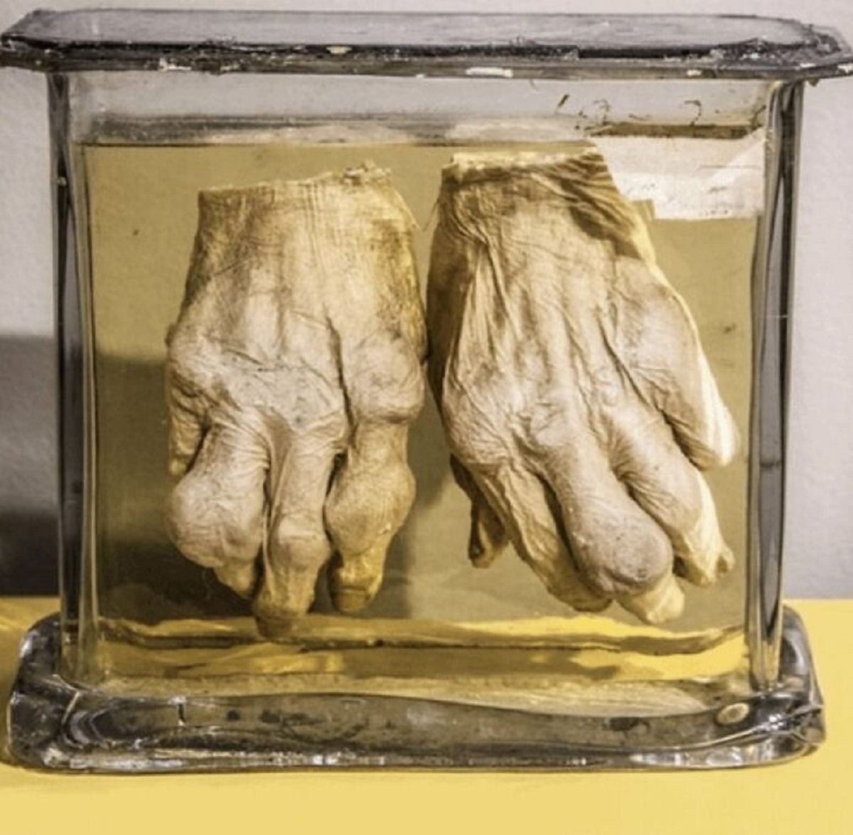 These are human hands, suffering from extreme gout. Dr. Thomas Dent Mütter saved them off of a deceased patient to study. He'd been suffering from the condition himself. Gout is a form of arthritis, where your joints become inflames and swollen.