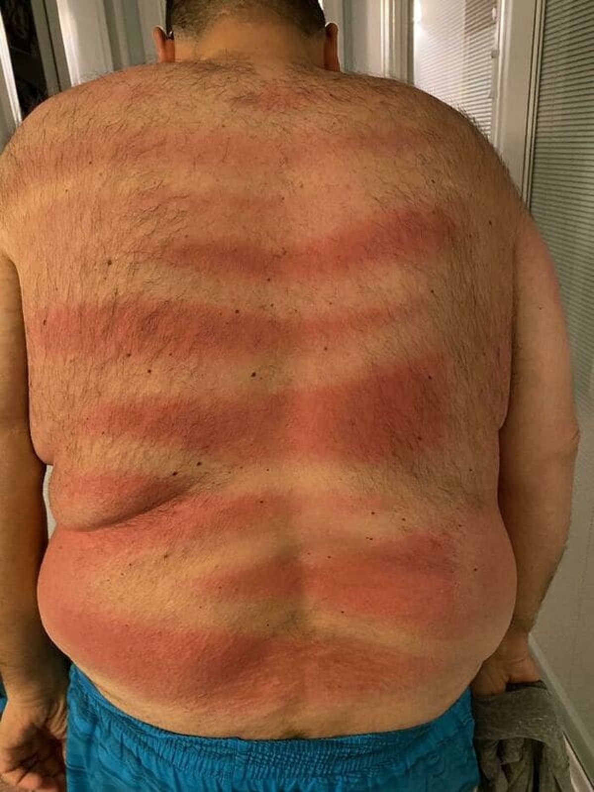 First Day At The Beach And My Wife Made Sure I Was Protected From Sunburn By Spraying My Back With Sunscreen. I Can’t See Back There – Did She Do A Good Job?