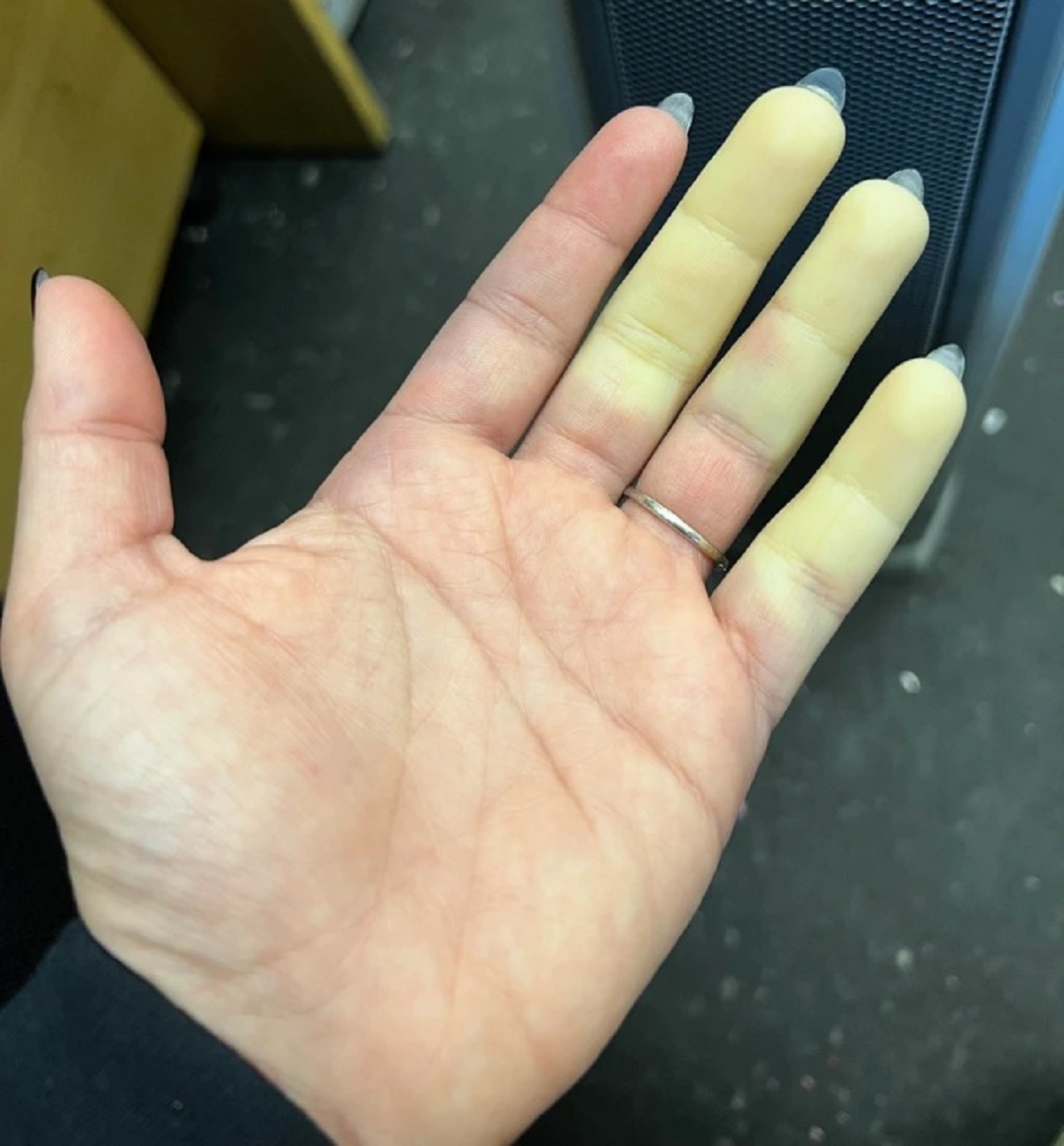 “Raynaud’s syndrome (phenomenon) on my hand this morning”