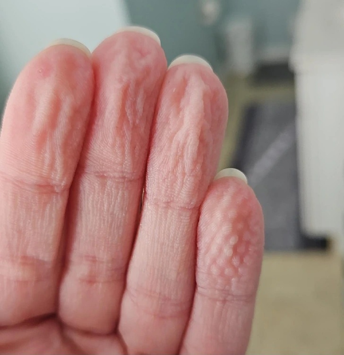 “My pinky finger after showering 1 day after I burned it.”