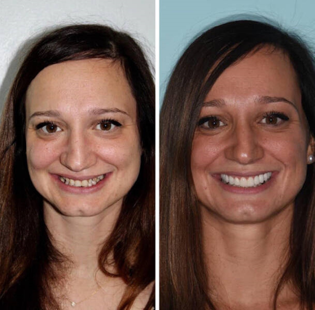 “Before and after dental veneers, weight loss, and self-care! (3 months)”