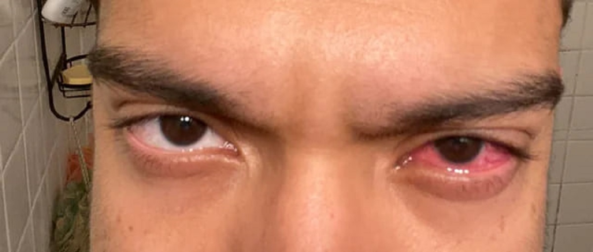 “Got punched in the eyeball while play fighting with an 8 y/o. This is day 4…”