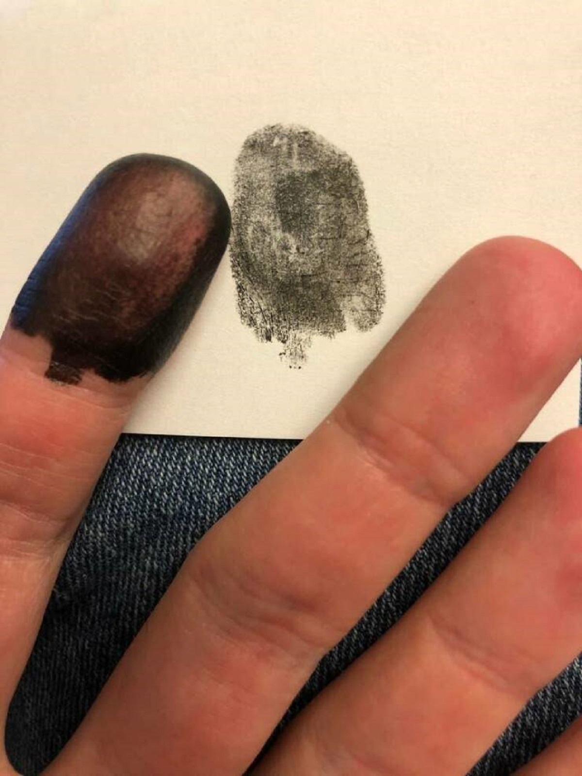 people born without fingerprints