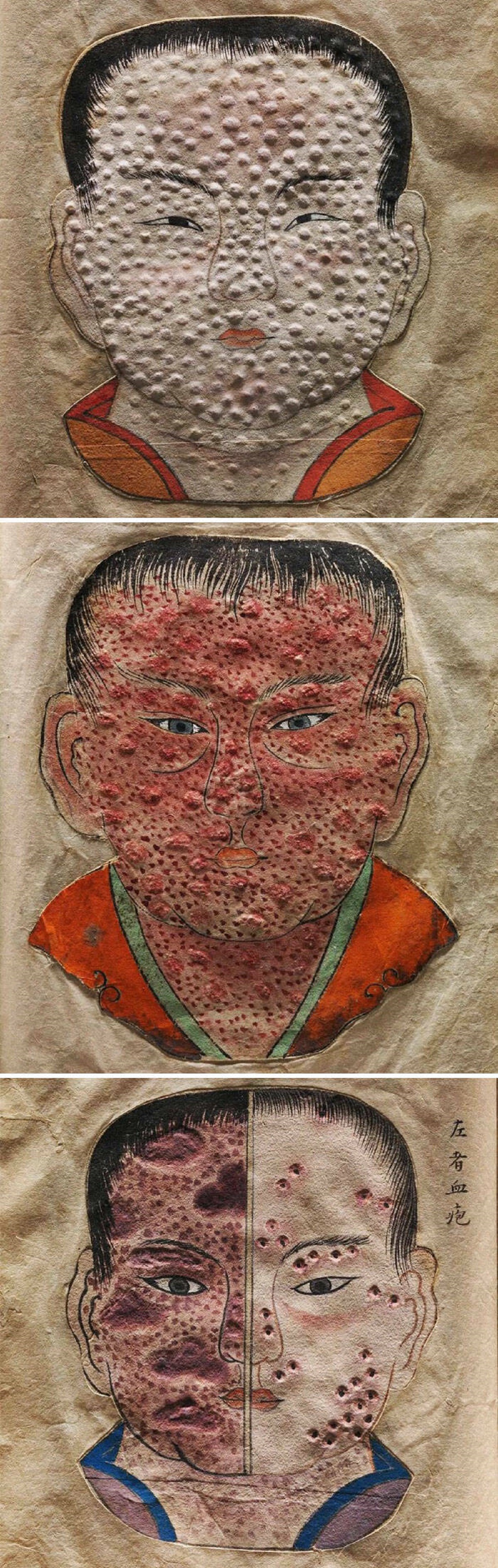 “Amazing Illustrations From A C.1720 Japanese Medical Book On Smallpox, Which Cleverly Uses Paper Embossing To Show The Changing Texture Of Smallpox Lesions During Different Stages Of The Disease”