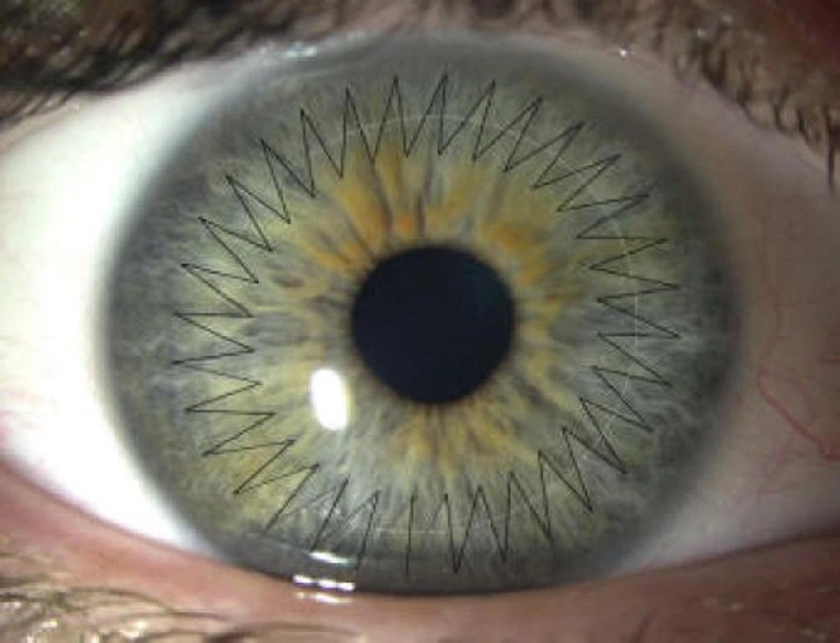 “Sutures after penetrating keratoplasty (cornea transplant).”