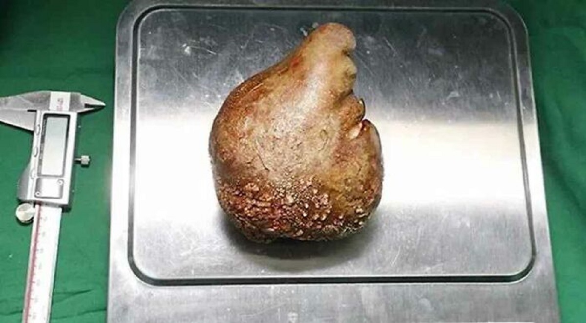 That the world’s largest kidney stone, removed from a patient in Sri Lanka, weighed 1.67 lbs (757.5g) and broke 2 world records.