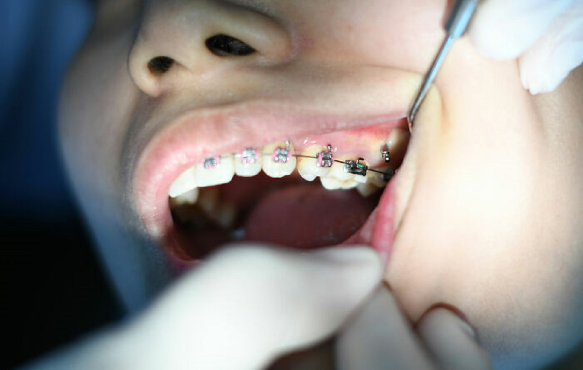 Putting a 9V battery on your braces is not a great idea. It melts the rubber bands and you have to explain it to the orthodontist.