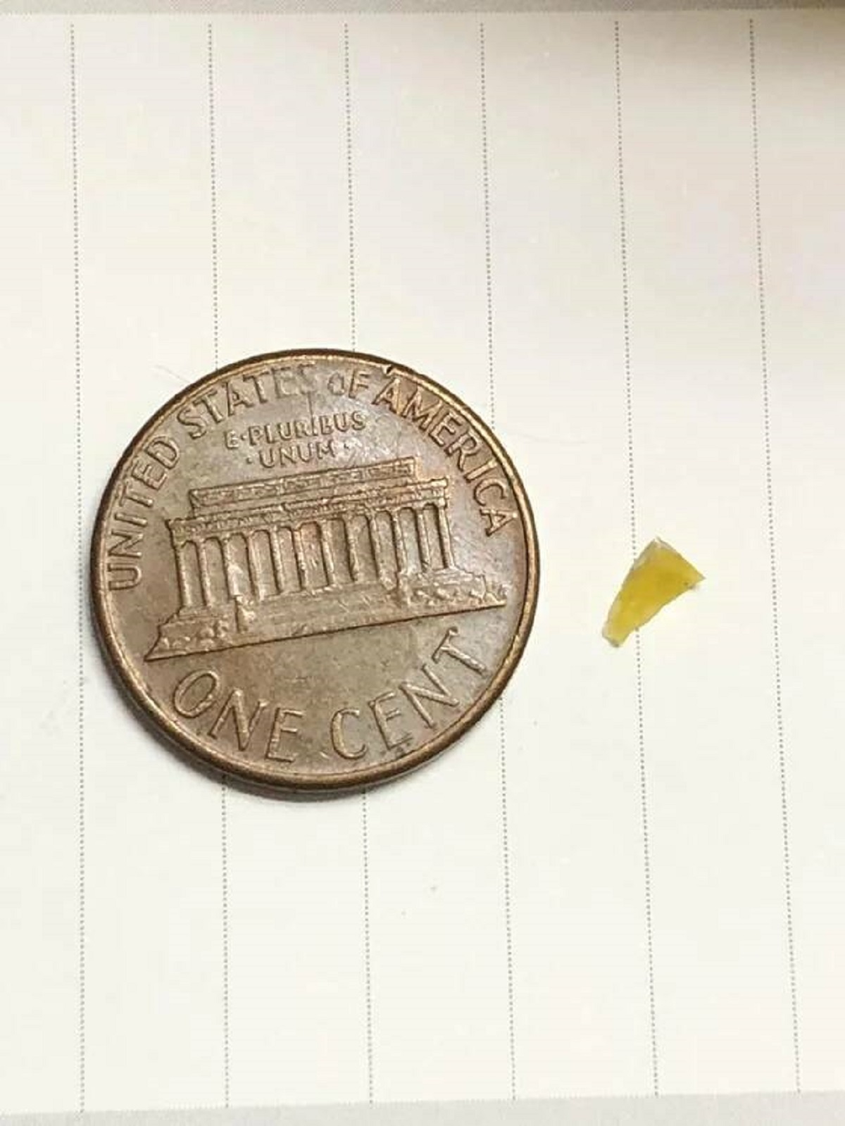 "Finally got out a piece of glass that’s been stuck in my foot for 7 years"