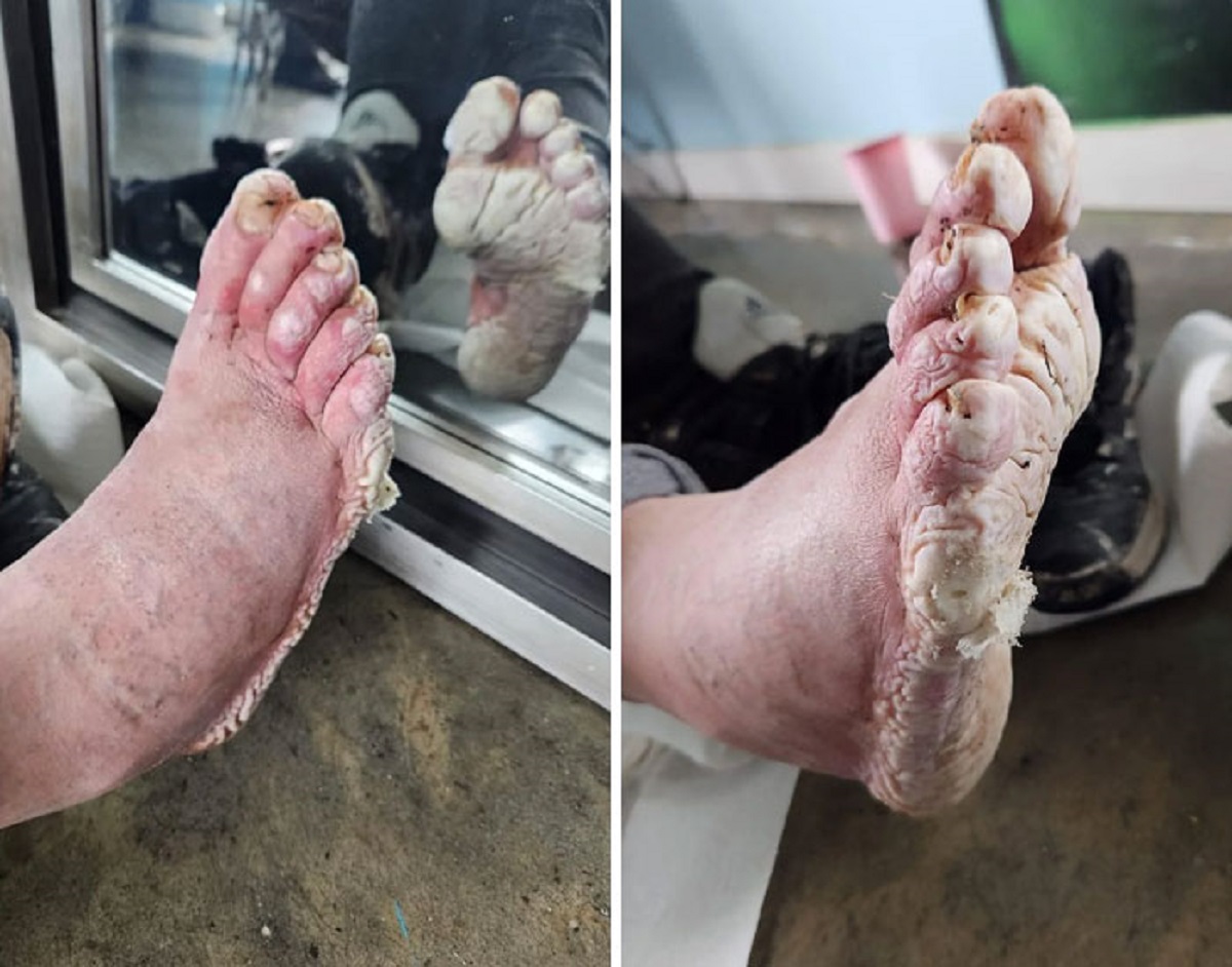 My Buddy Has Trenchfoot