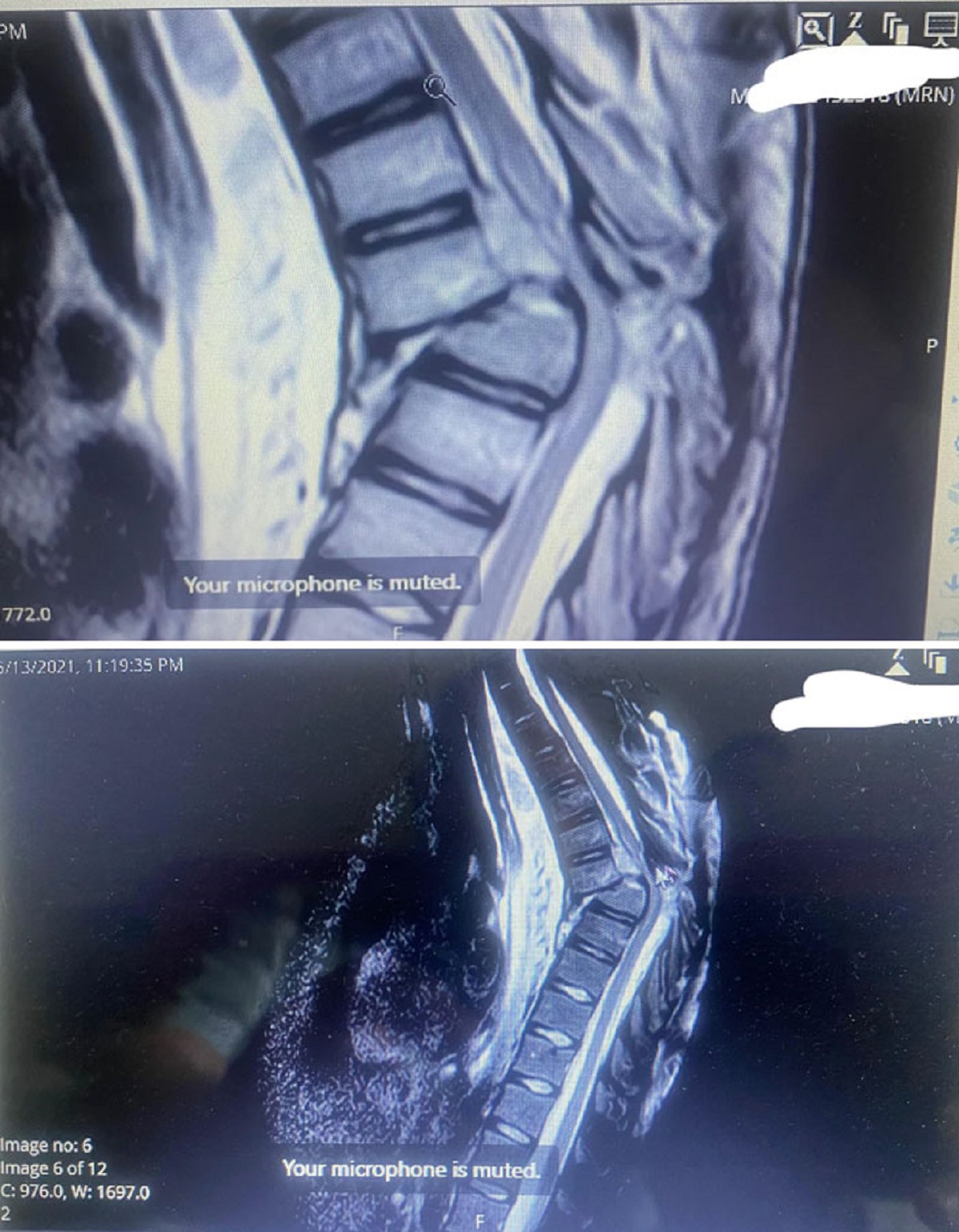 My Xray After Breaking My Back