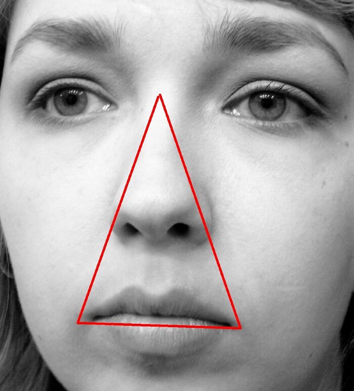 I would never pop a pimple in the danger triangle. This is the area from the bridge of the nose down to the upper lip, which forms a triangular area. Pop a pimple here, there's a chance that the bacteria from the skin can enter the bloodstream, which has a direct connection to the skull and the brain through something called a cavernous sinus. It can lead to serious infection as well as blindness or even death.