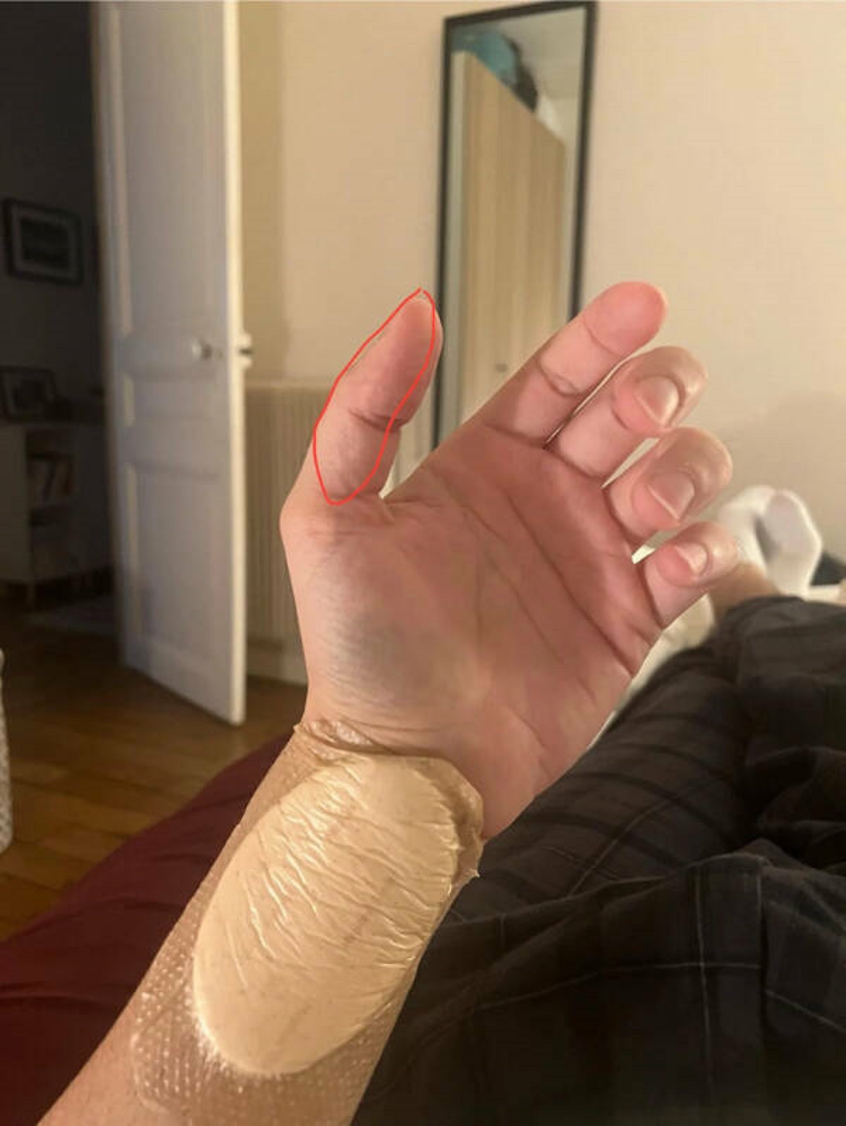 “Had wrist surgery, ended up loosing sensitivity on a huge part of my thumb.”