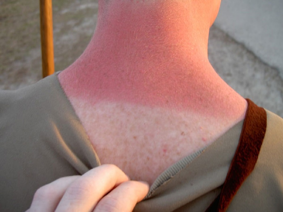 The pain you feel from a sunburn is your skin cells effectively killing themselves before they mutate into cancer.