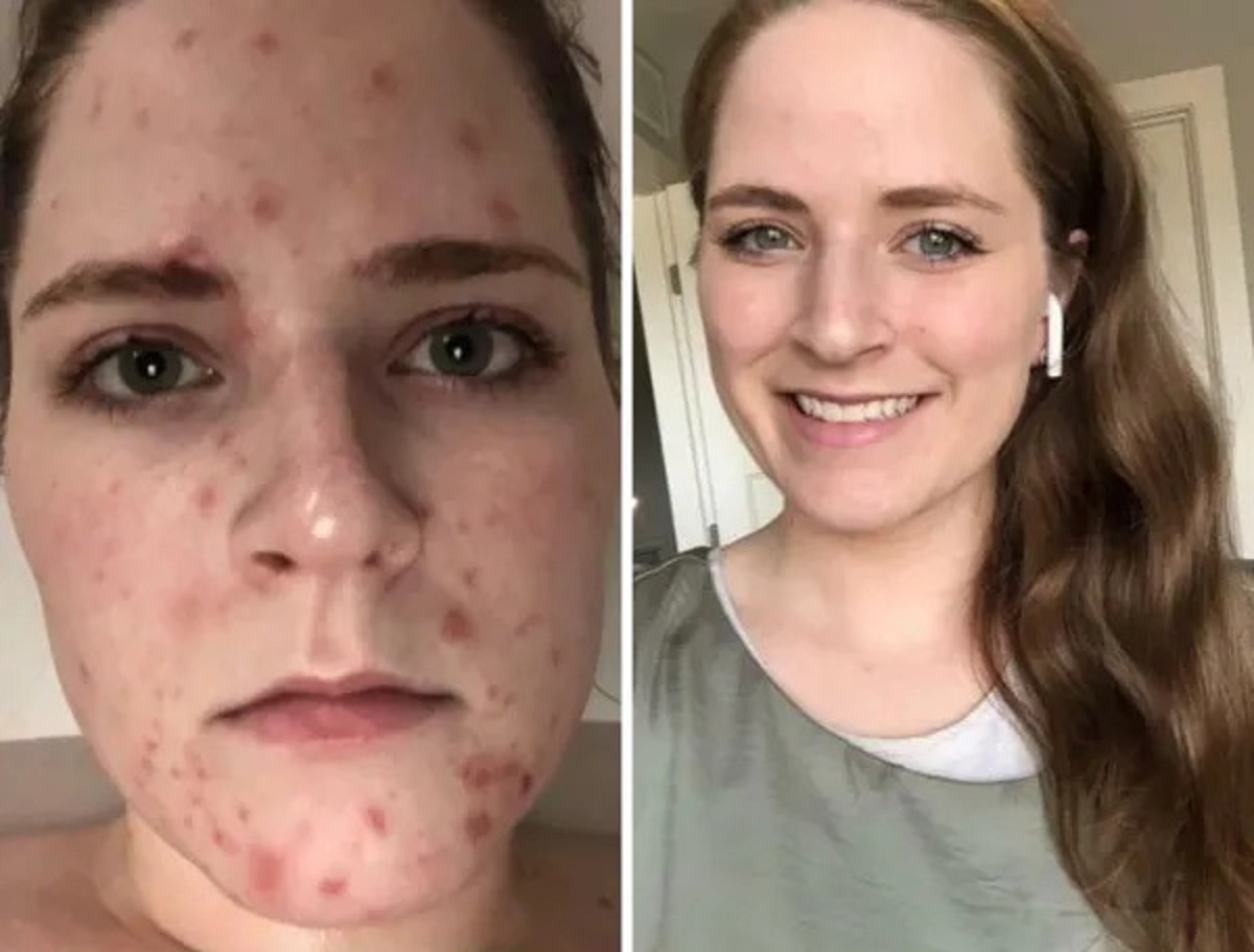 “A lot has changed in my life over this past year. I didn’t realize how much sobriety helped my skin until looking back at old photos. February, 2020 vs. Today”