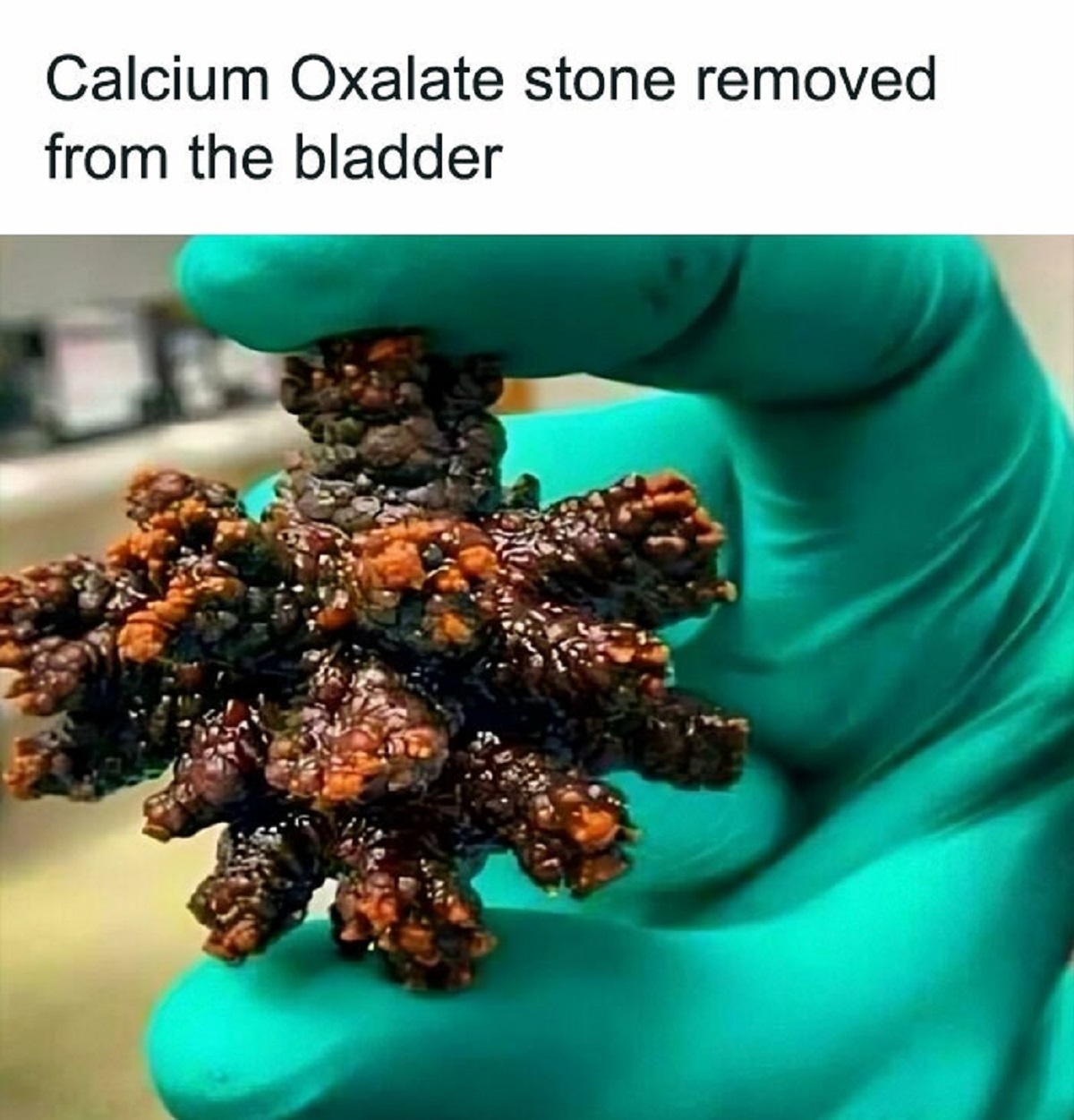biggest calcium oxalate stone - Calcium Oxalate stone removed from the bladder