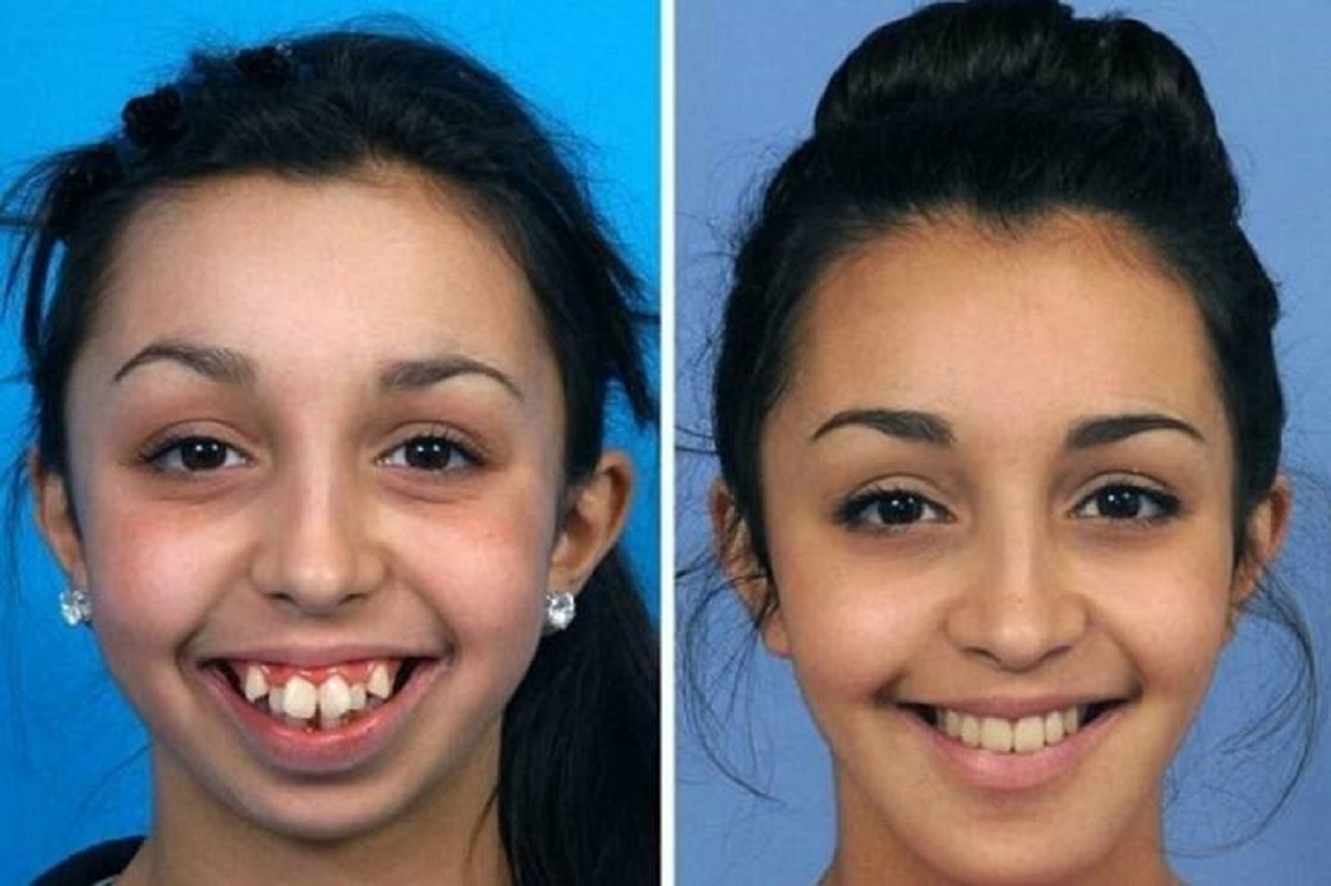Jaw surgery drastically alters girl’s facial look