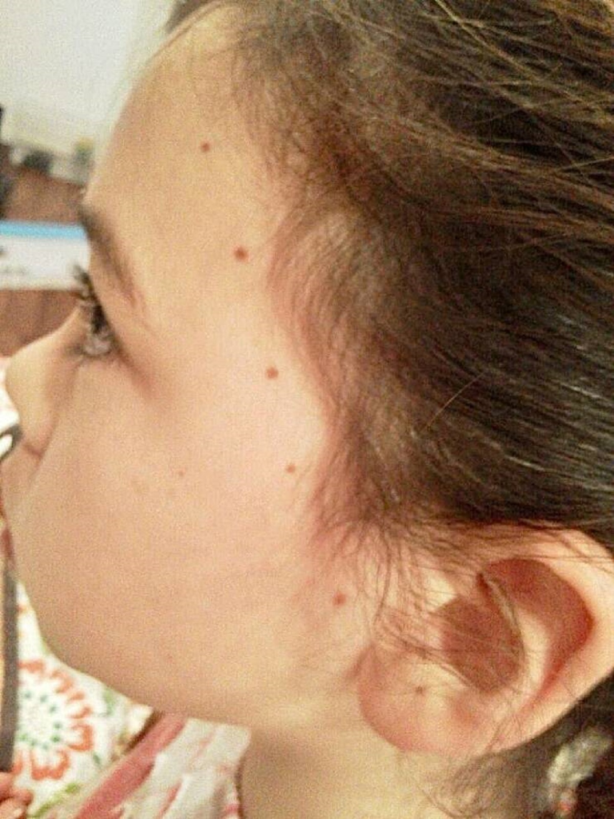 "My daughter’s freckles are in a straight line"