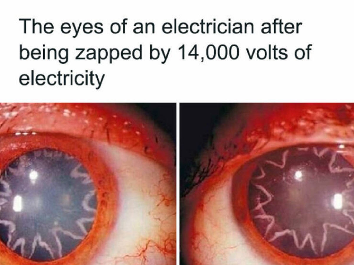 eyes of an electrician - The eyes of an electrician after being zapped by 14,000 volts of electricity
