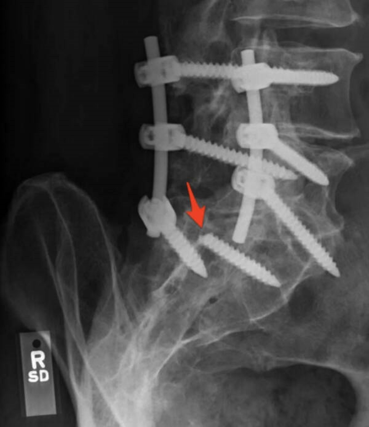 “One of the screws holding my spine in place snapped”