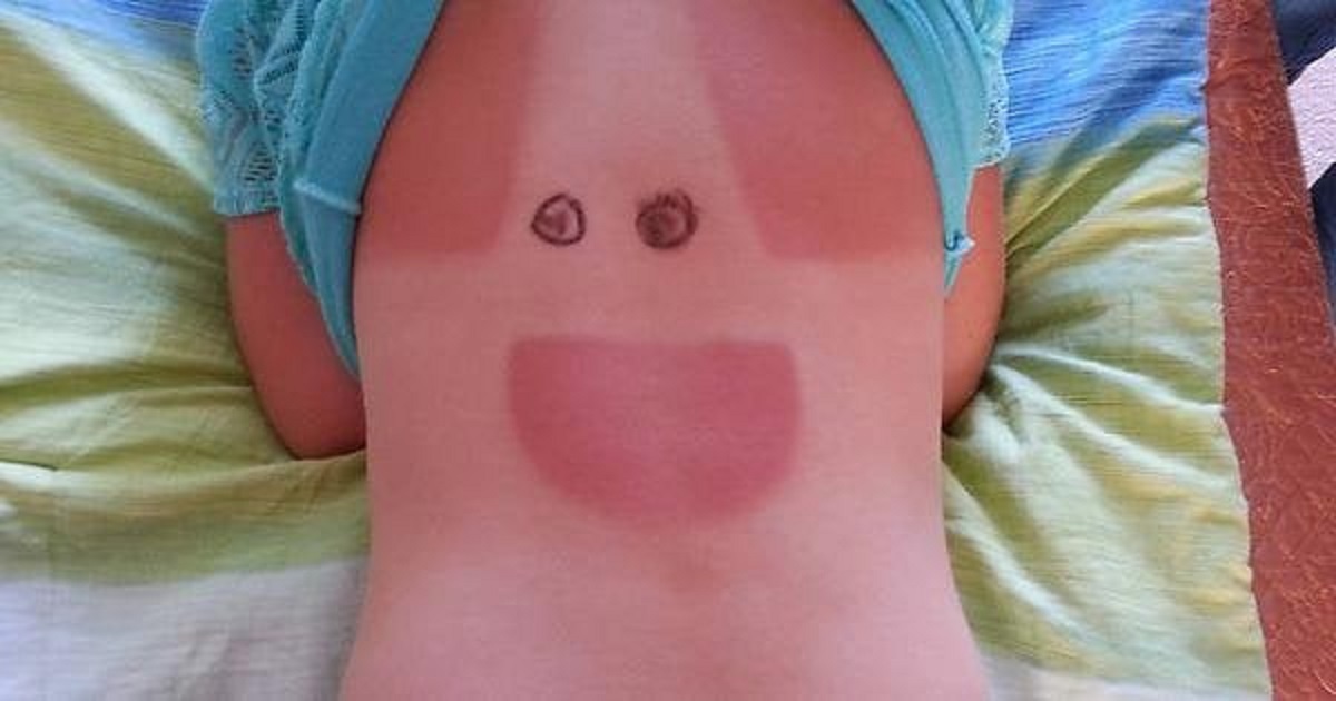 “Daughter’s sunburn looks like Patrick from Spongebob”
