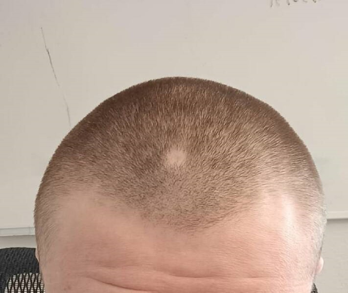"Didn't realise I had a bald spot until after I buzzed my hair"