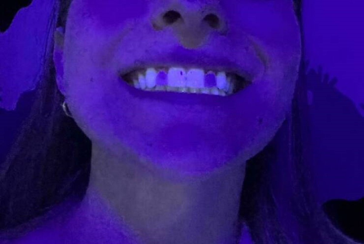 "My Two Porcelain Crowns Don’t Glow In Blacklight Like The Rest Of My Teeth"