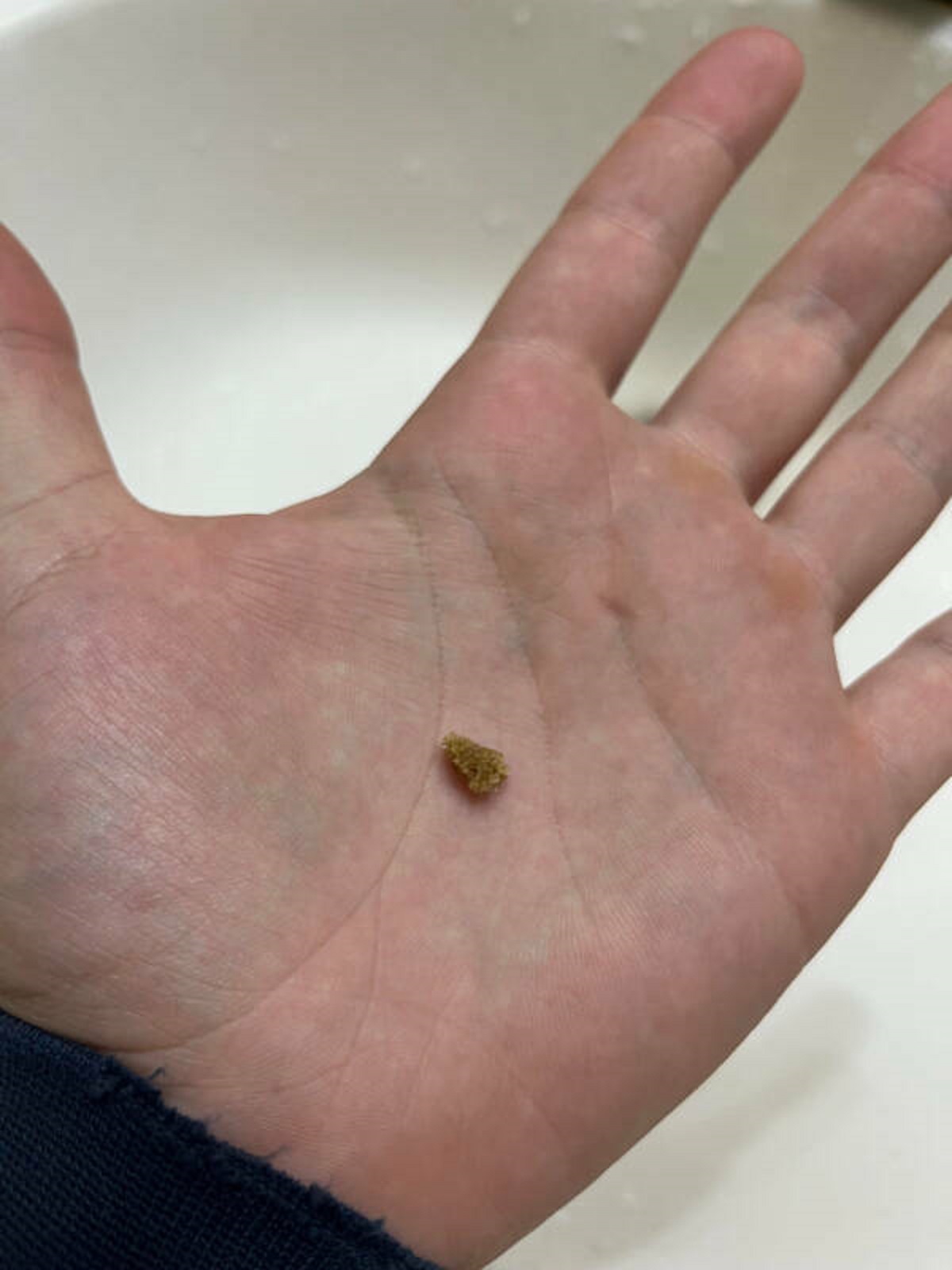 “Passed a kidney stone today”